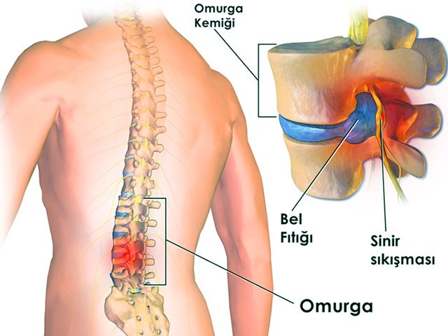 Bel Fıtığı Tedavisi